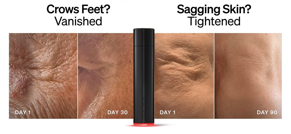 LYMA Laser Total Skin Transformation