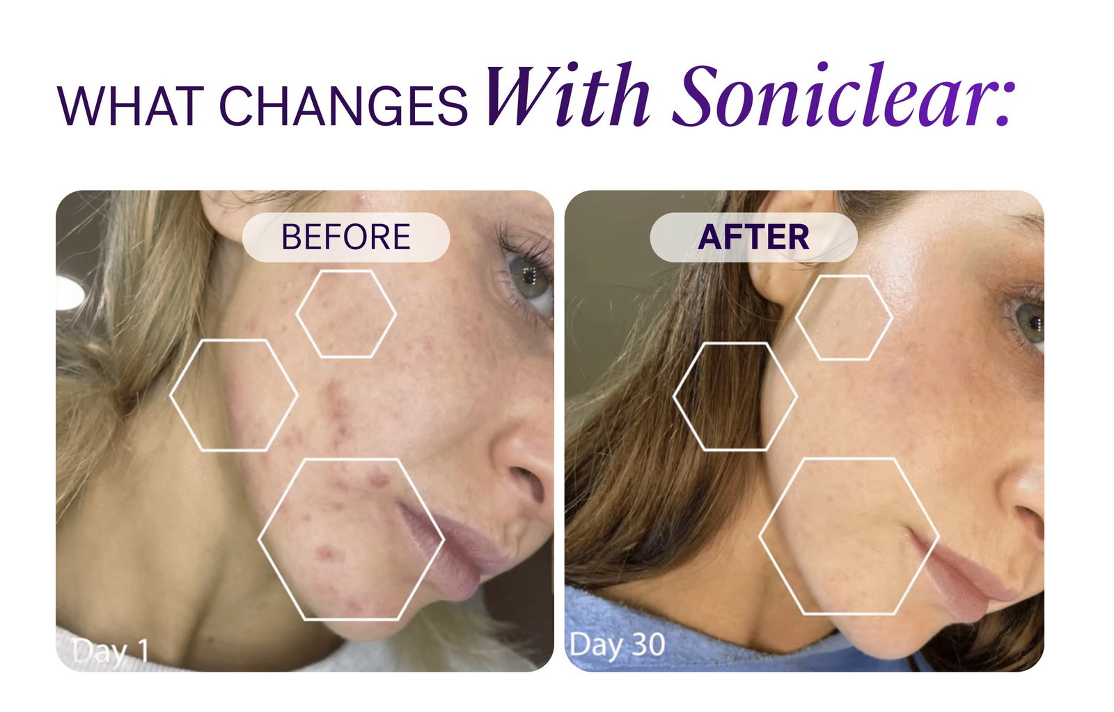You washed your face. So why is makeup still coming off?   If it’s still there, It was never fully gone. That leftover residue sits on your skin overnight clogging pores, dulling your glow and affecting texture more than you think.   Soniclear fixes what your hands can’t. With an oscillating brush head and antimicrobial bristles, it lifts what basic cleansing leaves behind. What Changes With Soniclear: