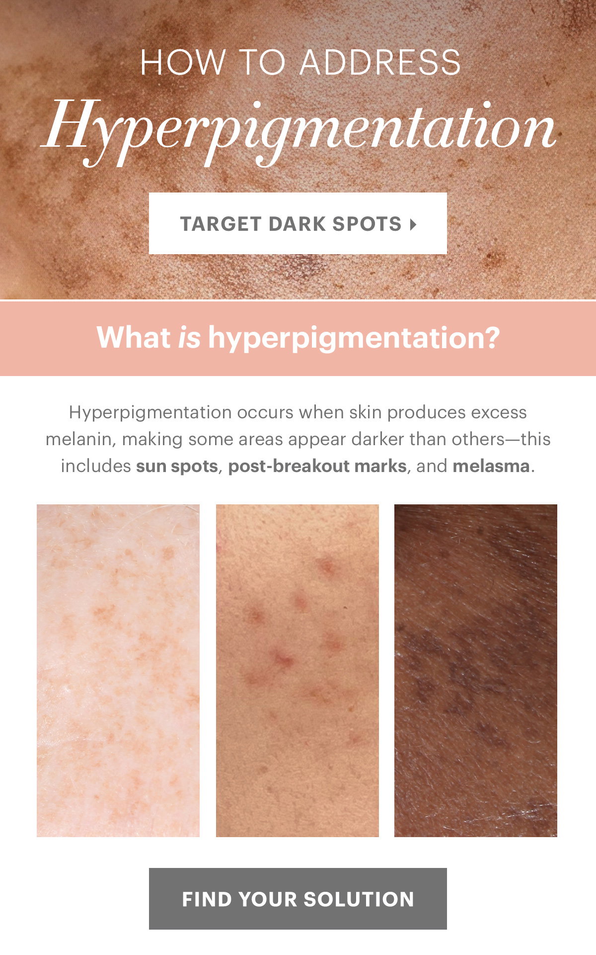  HOW TO ADDRESS: Hyperpigmentation Hyperpigmentation occurs when skin produces excess melanin, making some areas appear darker than others—this includes sun spots, post-breakout marks, and melasma