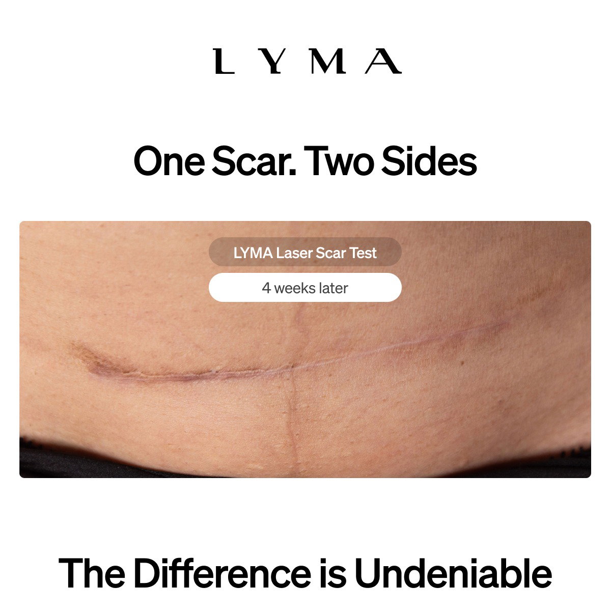 LYMA Laser