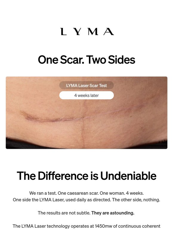 One scar. 4 weeks. Astounding results.
