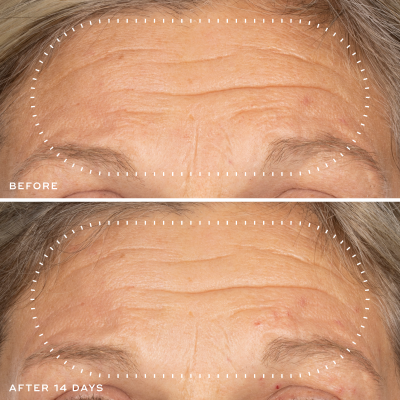 Wrinkle Reduction