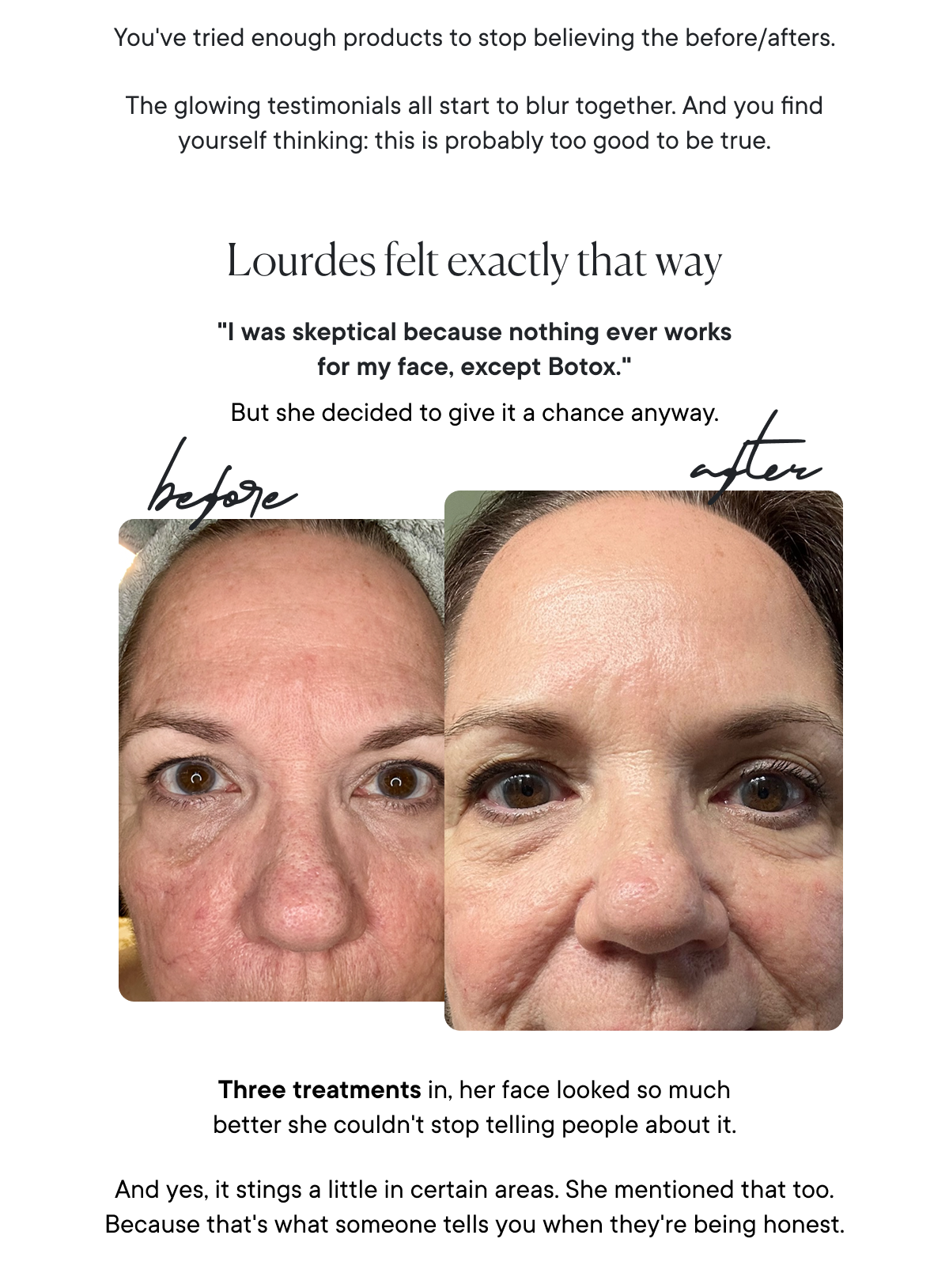 "I was skeptical because nothing ever works for my face, except Botox."