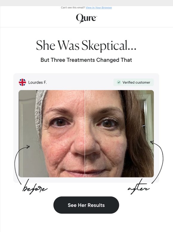 She thought only Botox would work…