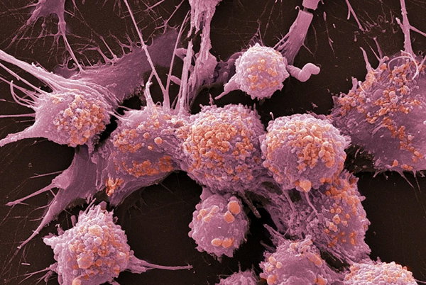 A scanning electron microscopy image of prostate cancer cells.