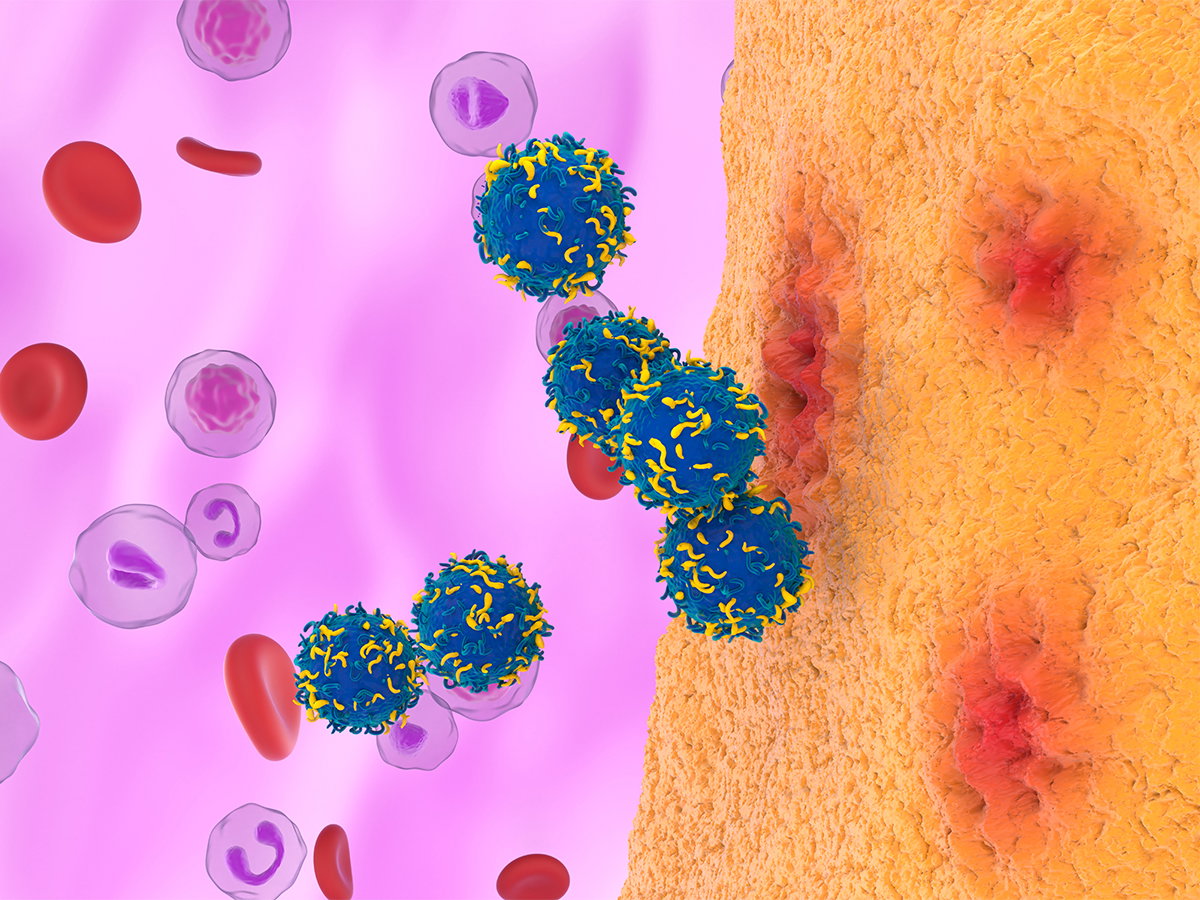 Illustration of CAR T cell therapy in rheumatoid arthritis