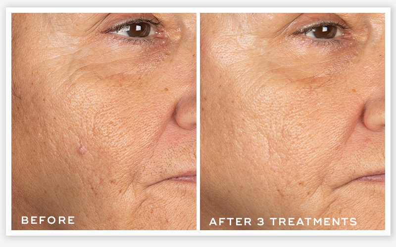 Side-by-side before and after images of a woman’s cheek area showing visible lines and skin texture. The after image, labelled “After 3 treatments,” shows smoother, more refined-looking skin compared to the “Before” image.