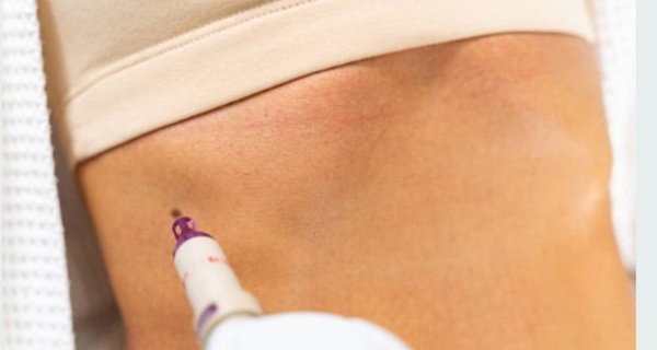 Morpheus8 RF Micro-Needling for Face & Neck or Abdomen