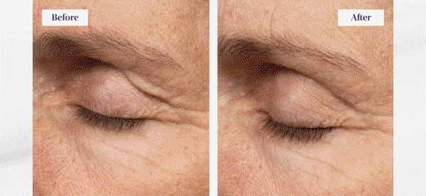 SAVE 30% OFF EYE LIFT WAND