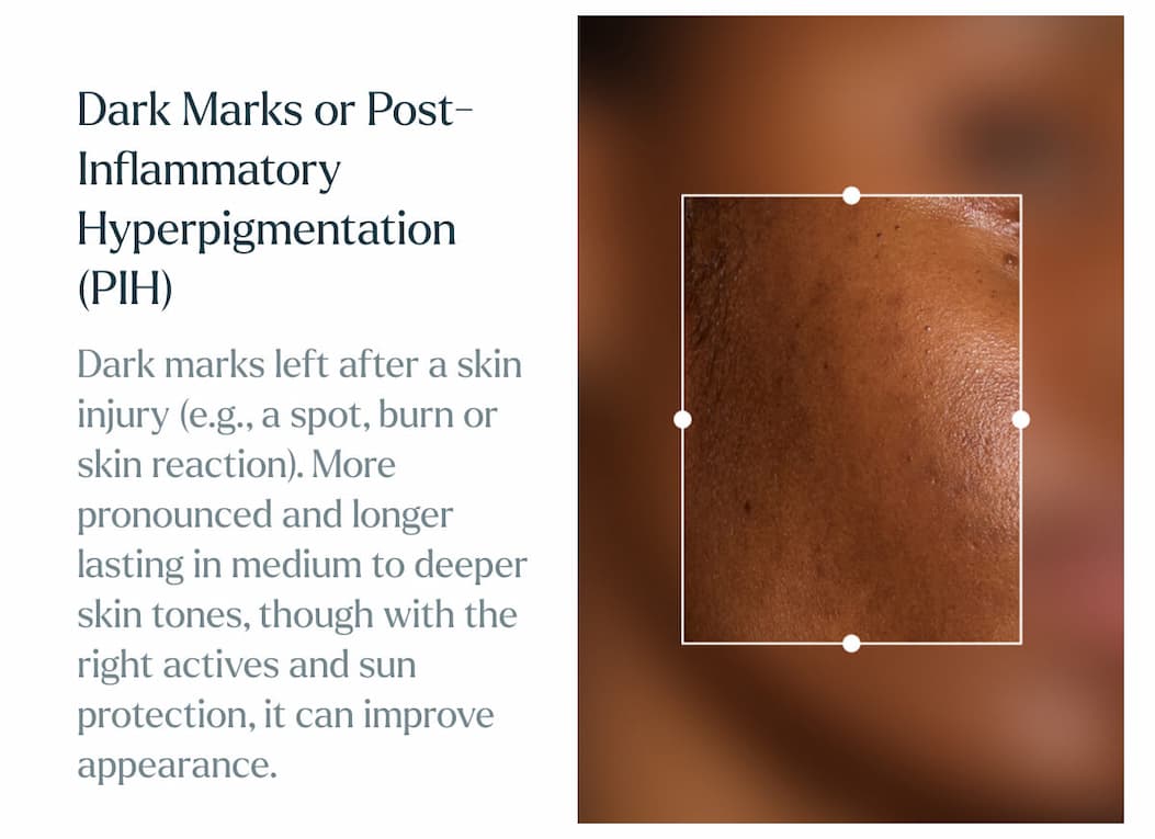 Dark Marks or Post Inflammatory Hyperpigmentation