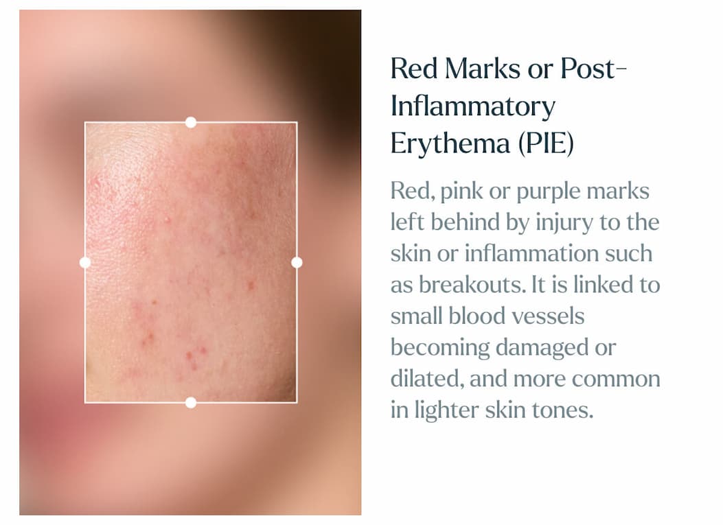 Red Marks or Post Inflammatory Hyperpigmentation