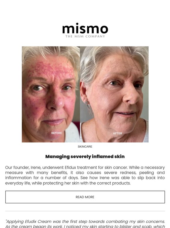 When your skin is at its worst — raw, visible, uncomfortable — the last thing you want is to stay home.