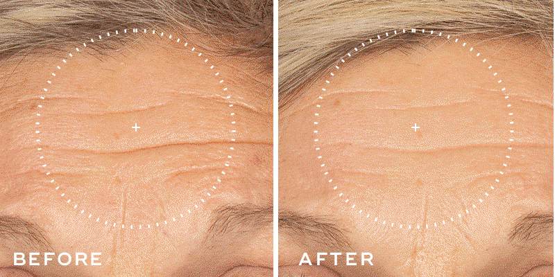 Before-and-after comparison of forehead skin showing visible wrinkles in the highlighted area before treatment and smoother-looking skin after use.