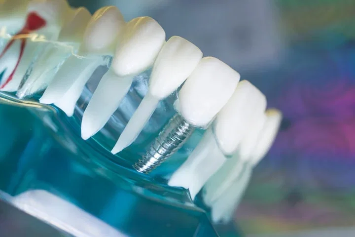 Konsultation: Implantat, tandreglering + 5000 kr presentkort hos DermaDent