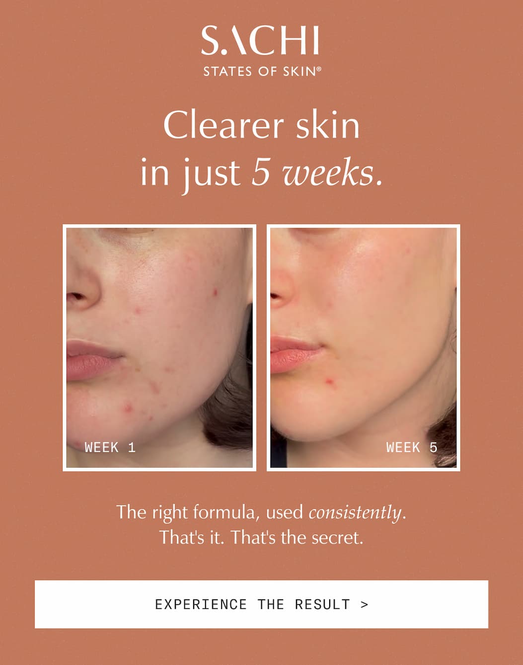 Clearer skin in just 5 weeks.