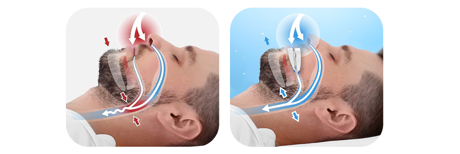 Illustration showing how a blocked airway can cause snoring and how opening the airway may help improve breathing during sleep.