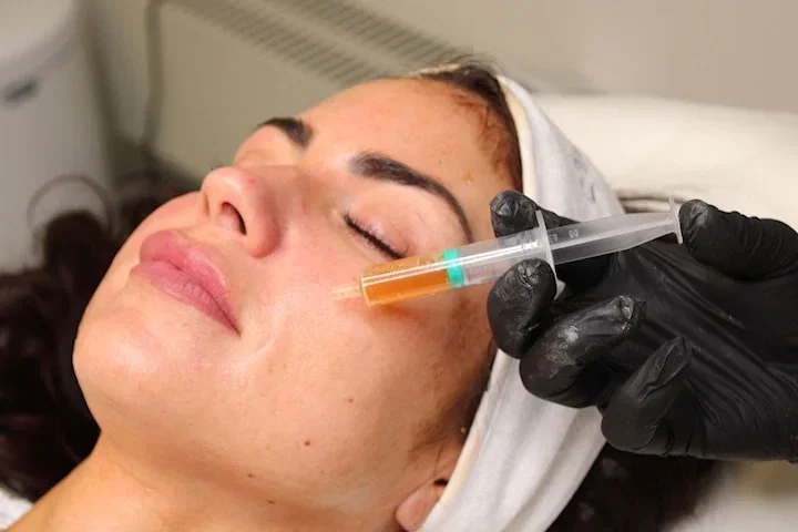 Microneedling med PRF för hudföryngring i Solna centrum