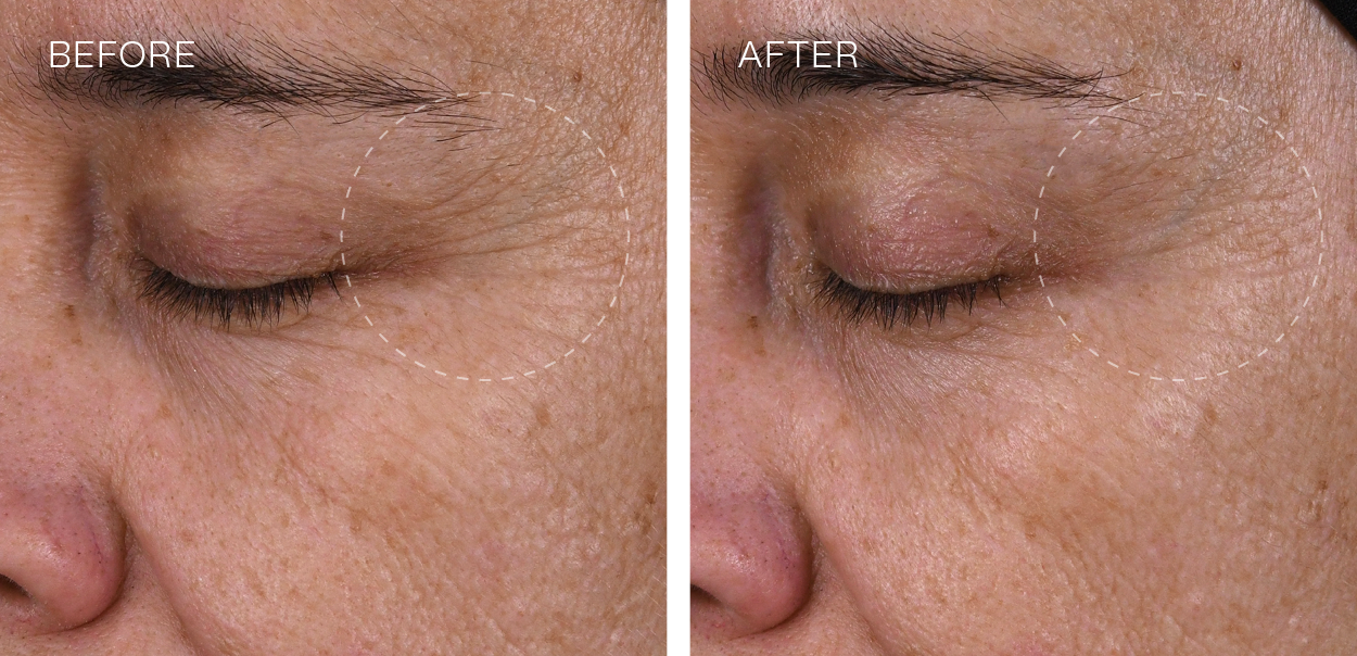 SuperSerum+ Before and After