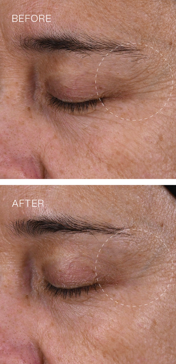 SuperSerum+ Before and After