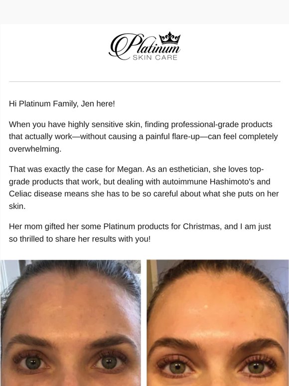 "I am blown away by Platinum!" - Megan's Sensitive Skin Success ✨