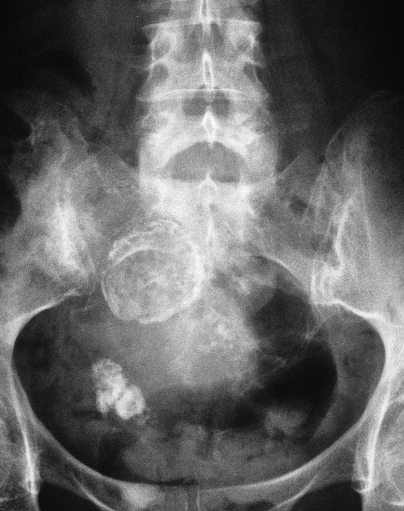 A front-facing pelvic X-ray showing calcified cysts in a woman's ovary (white, lower left).