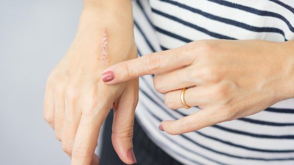 8 conseils pour bien cicatriser