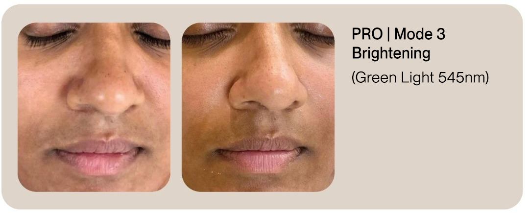 PRO Before & After | Mode 3 Brightening (Green Light 545nm)