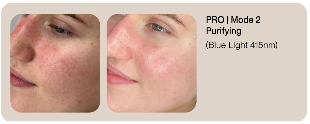 PRO Before & After | Mode 2 Purifying (Blue Light 415nm)