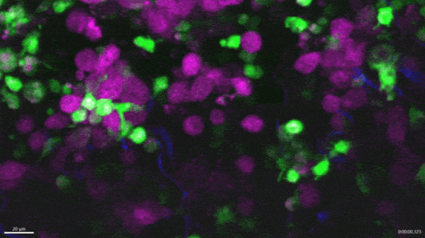 A moving imaging of macrophages engulfing melanoma cells.