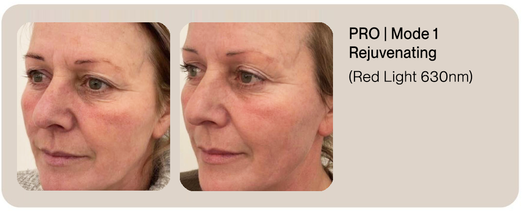 PRO Before & After | Mode 1 Rejuvenating (Red Light 630nm)