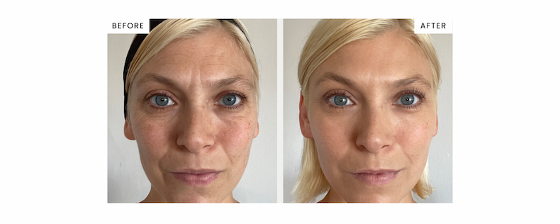 Before and after serum 
