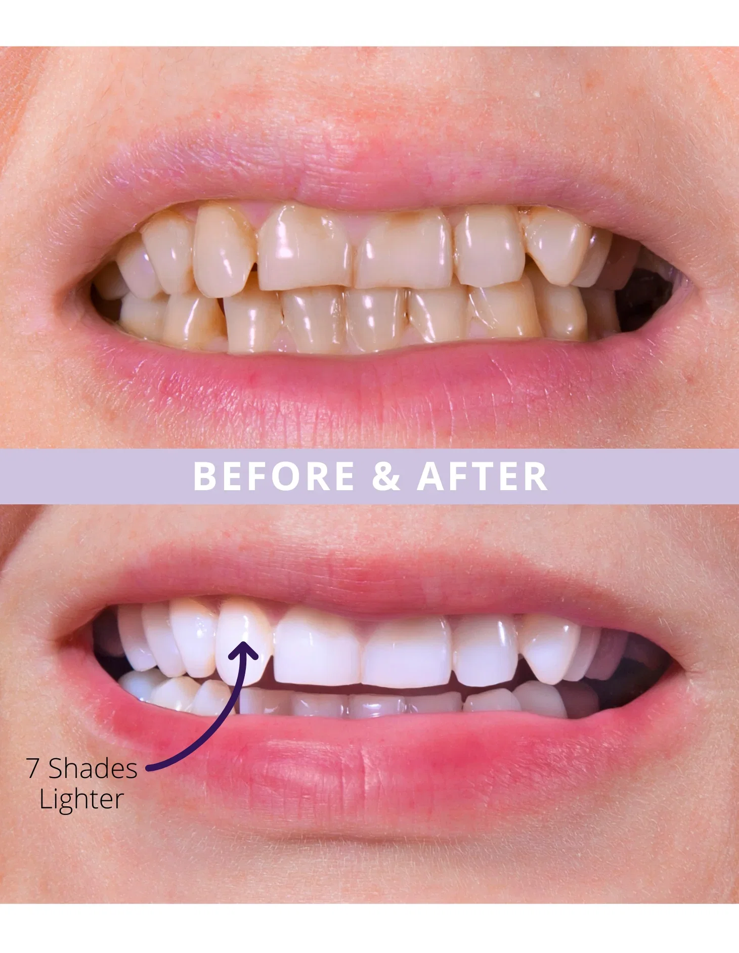 Magic Melt-Away Teeth Whitening Masks (14 days + BONUS 7 days for touch-ups)