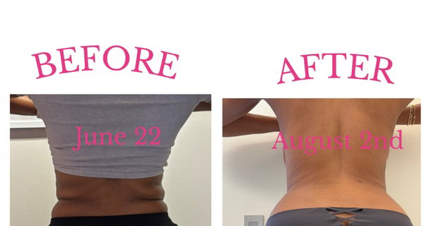 Discover the Power of Venus Bliss:  Laser Lipolysis Treatments at Black Bella Dc Body Sculpting (Up to 40% Off)