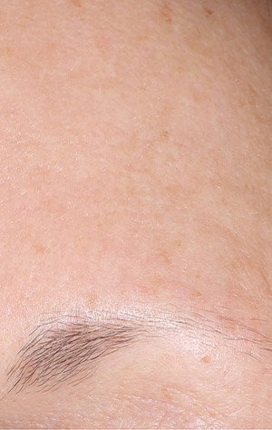 Same forehead with improved appearance of pores and wrinkles