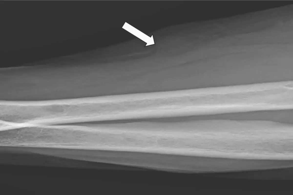 Woman in cancer remission without treatment in highly unusual case. Image leads to article.