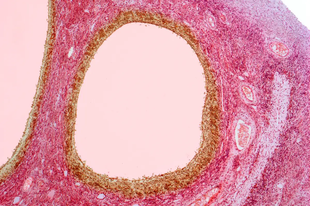 PCOS has been officially renamed PMOS, and it’s a momentous move. Image leads to article.