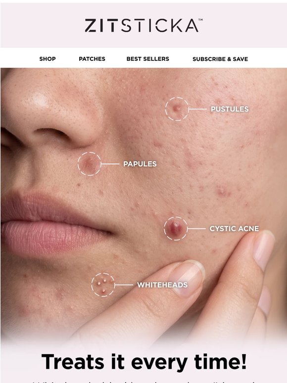 Get the Cheat Sheet for Clear Skin