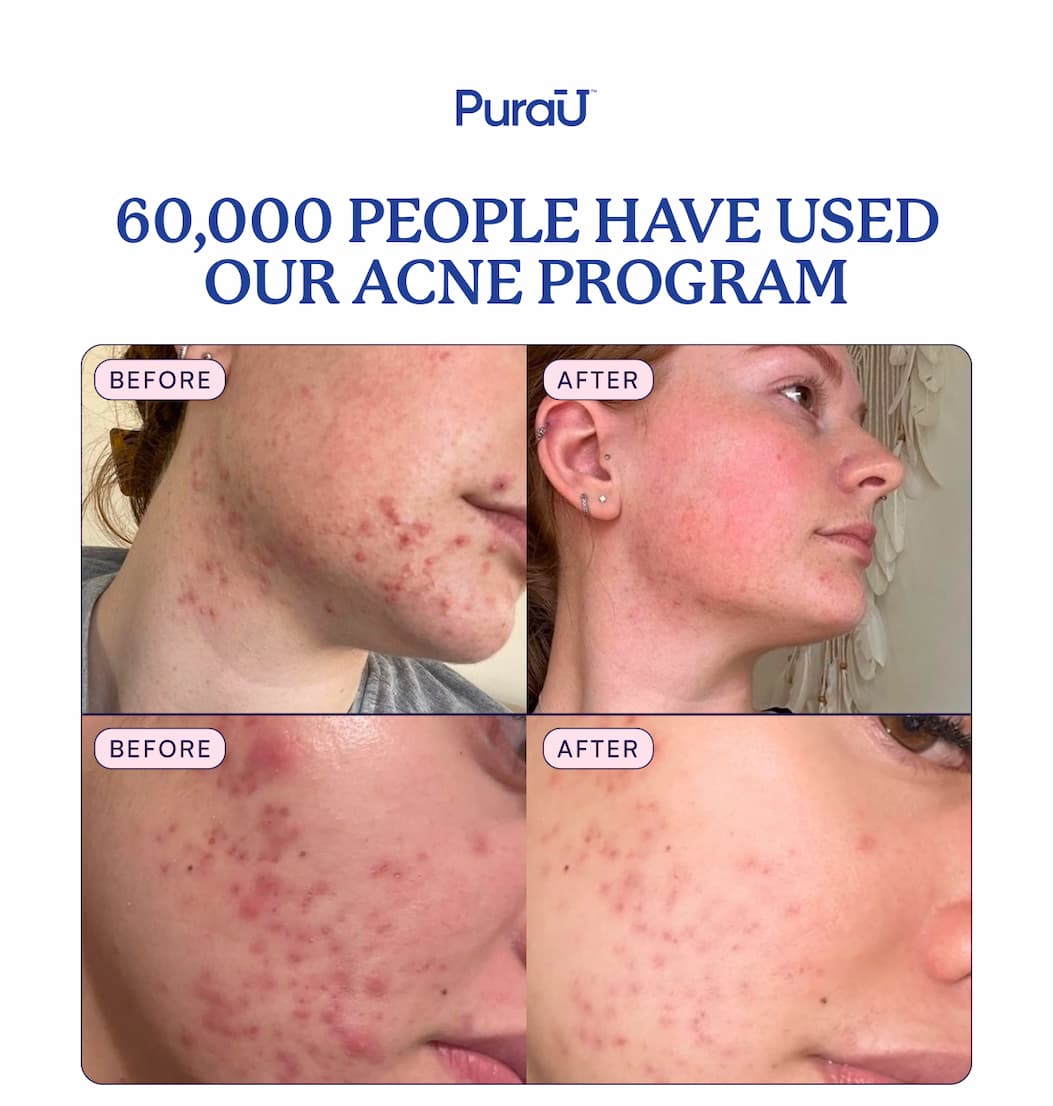 60,000 People Have Used Our Acne Program | See the results