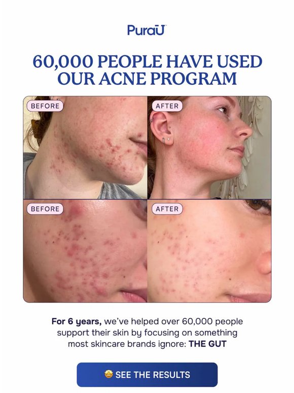 60,000 people have used our Acne Program. Here’s why.