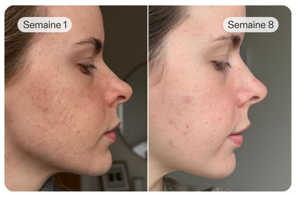 Masque led visage avant après