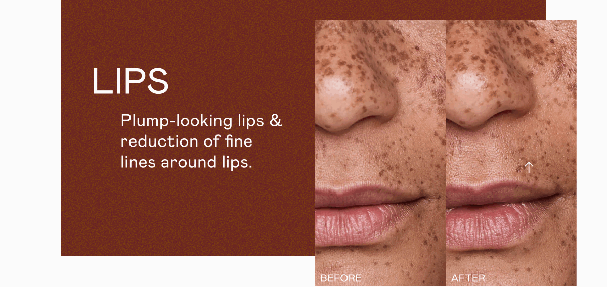 Lips - Plump-looking lips & reduction of fine lines around lips.