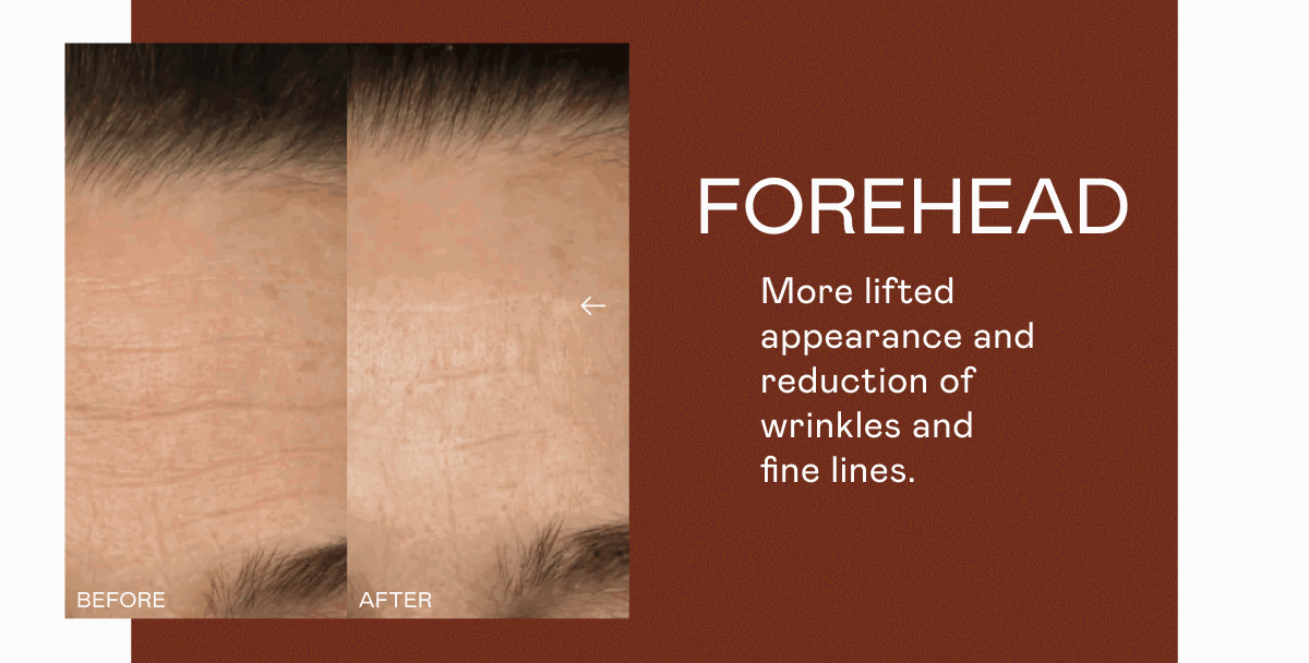 Forehead - More lifted appearance and reduction of wrinkles and fine lines.