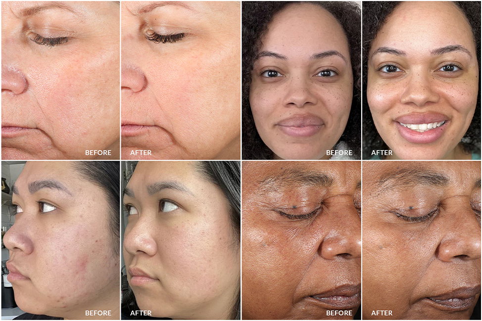 Personal Microderm Before+After