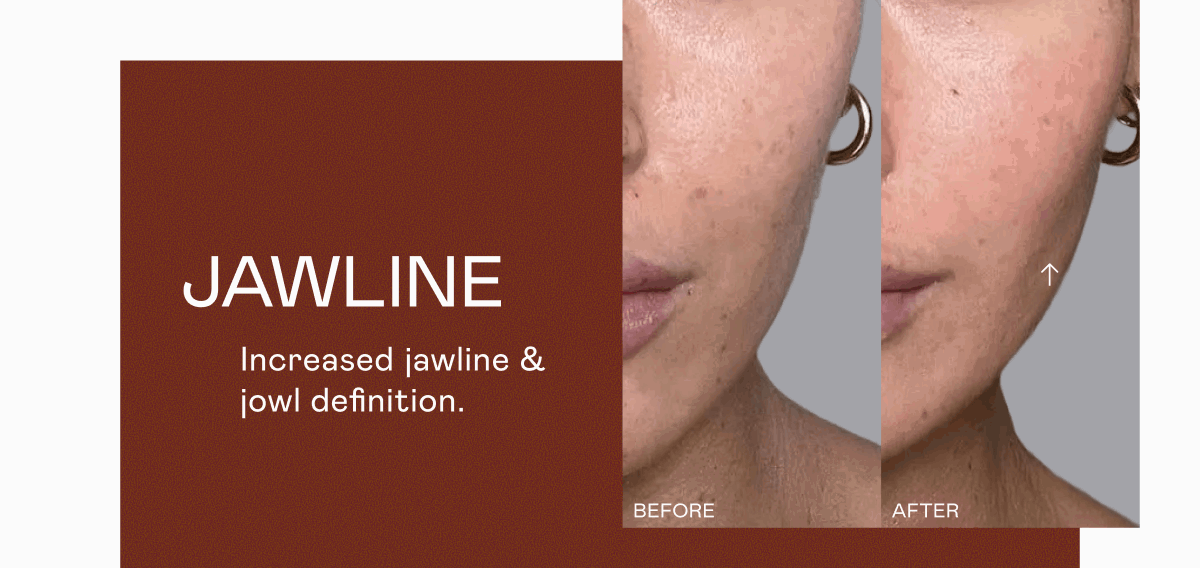 Jawline - Increased jawline & jowl definition.