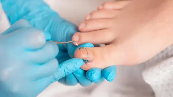 Comment soigner un ongle incarné?