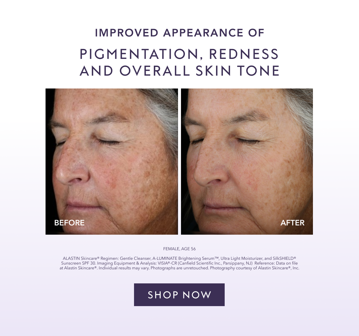 Improved Appearance of Pigmentation, Redness, And Overall Skintone