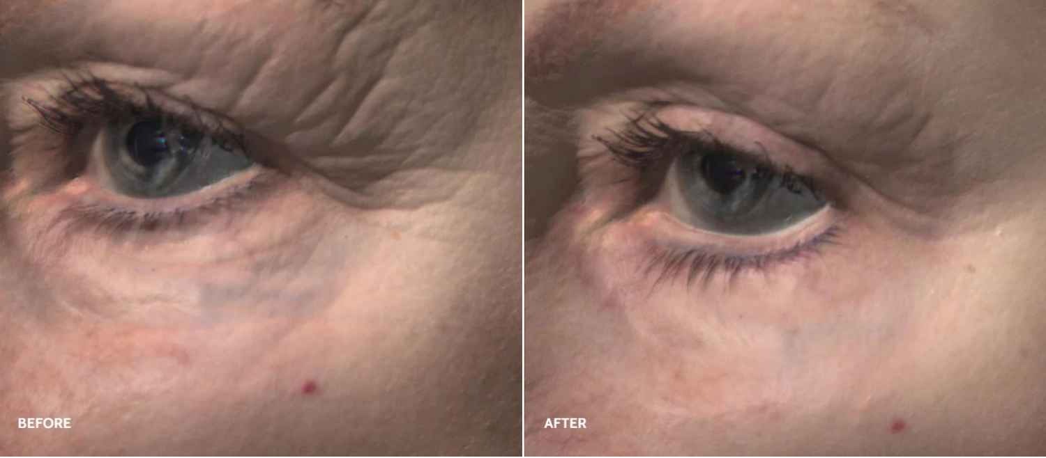 an image of a woman's left eye with wrinkles and wrinkles