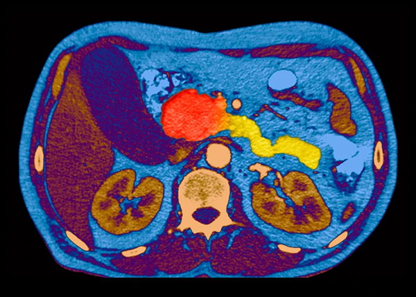 A coloured computed tomography scan through an individual’s abdomen, showing the red, round mass of a cancerous tumour in the head of the pancreas.