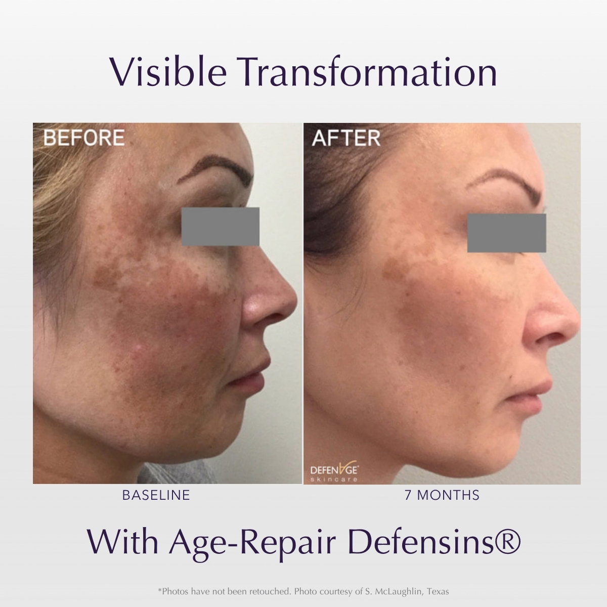 Melasma B/A