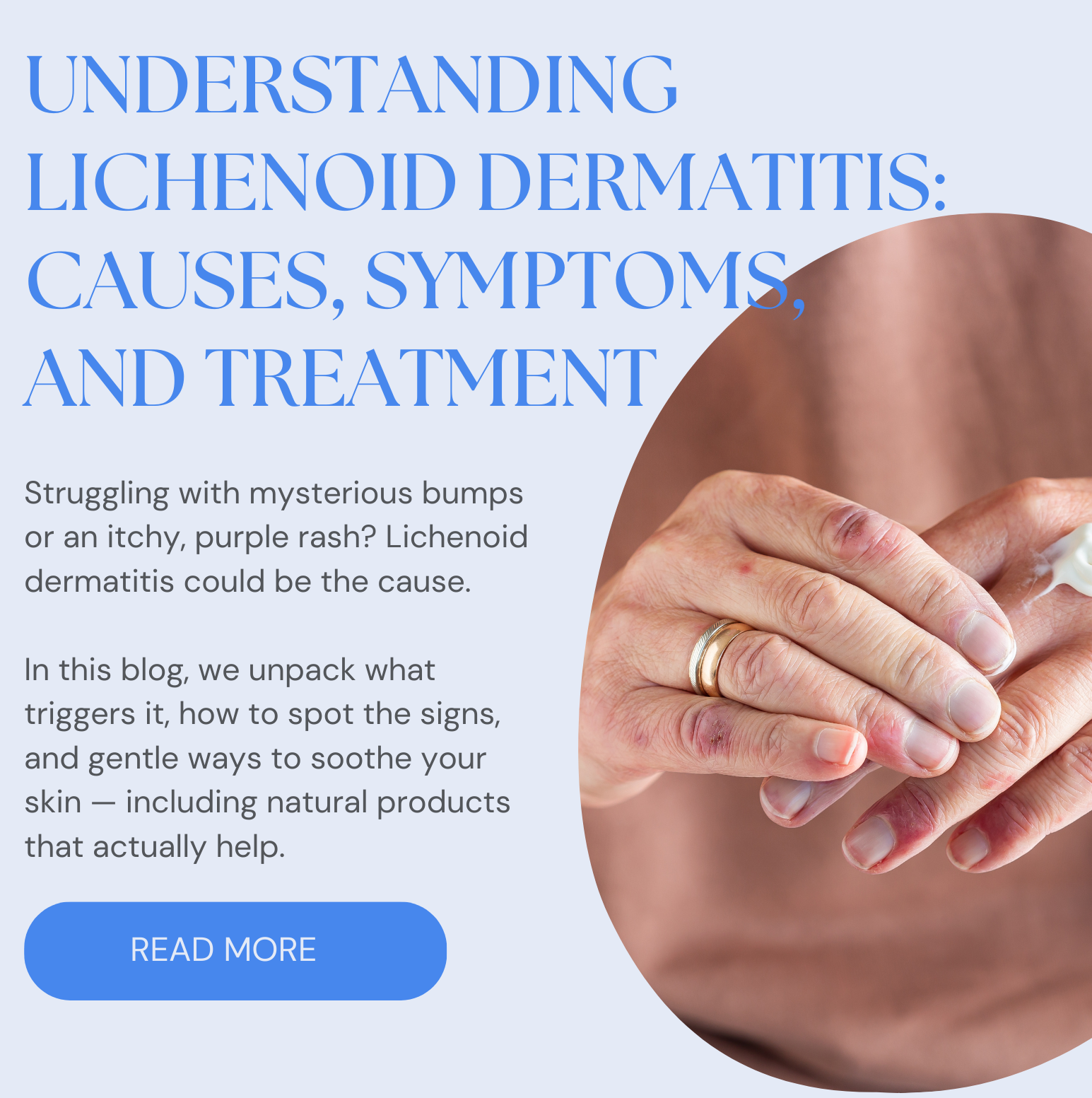 Understanding Lichenoid Dermatitis: Causes, Symptoms, and Treatment
